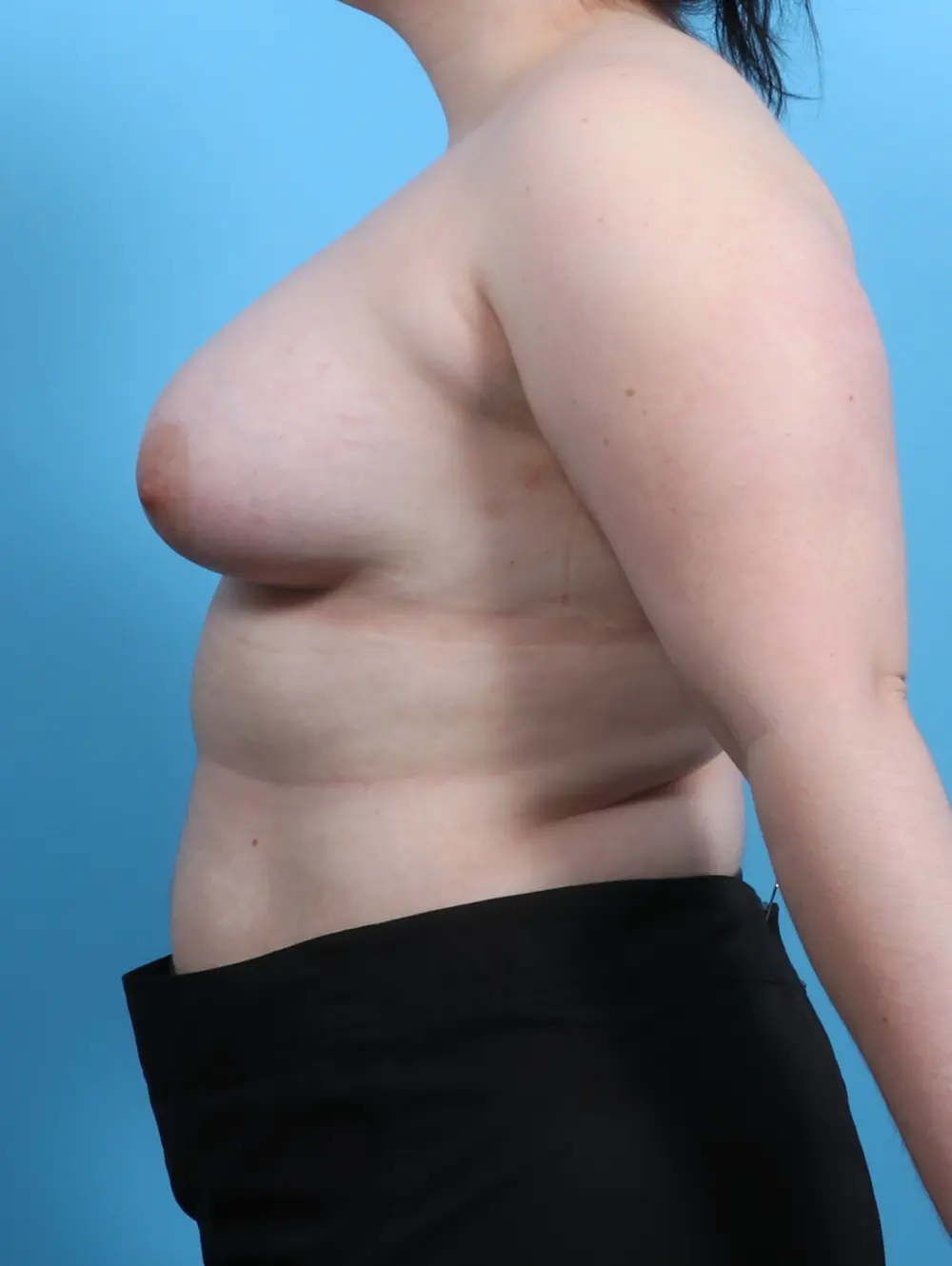 Breast Augmentation Patient Photo - Case 26604 - after view-2