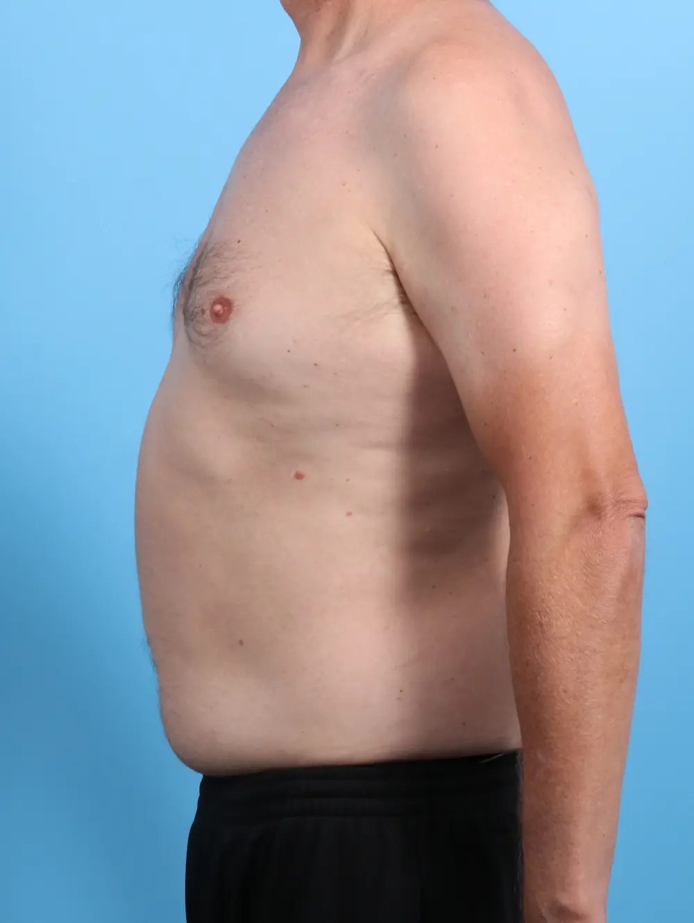 Male Liposuction Patient Photo - Case 26626 - before view-2