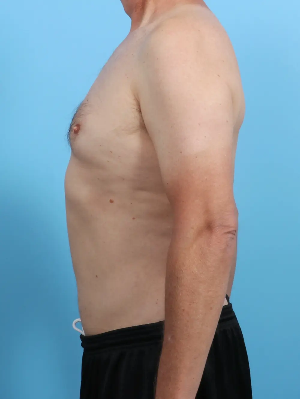 Male Liposuction Patient Photo - Case 26626 - after view-2