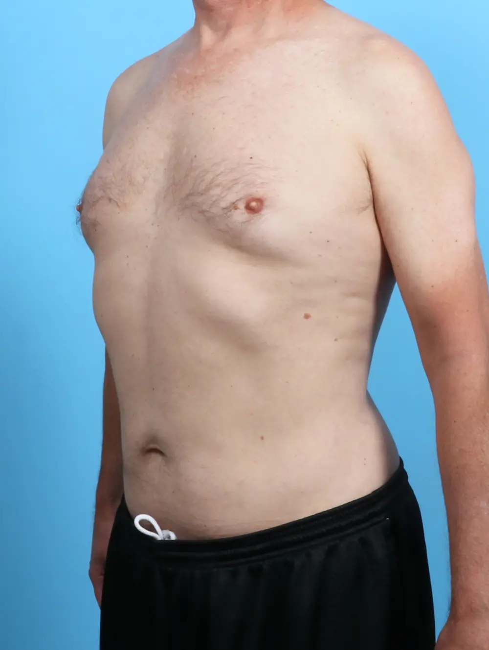 Male Liposuction Patient Photo - Case 26626 - after view-1