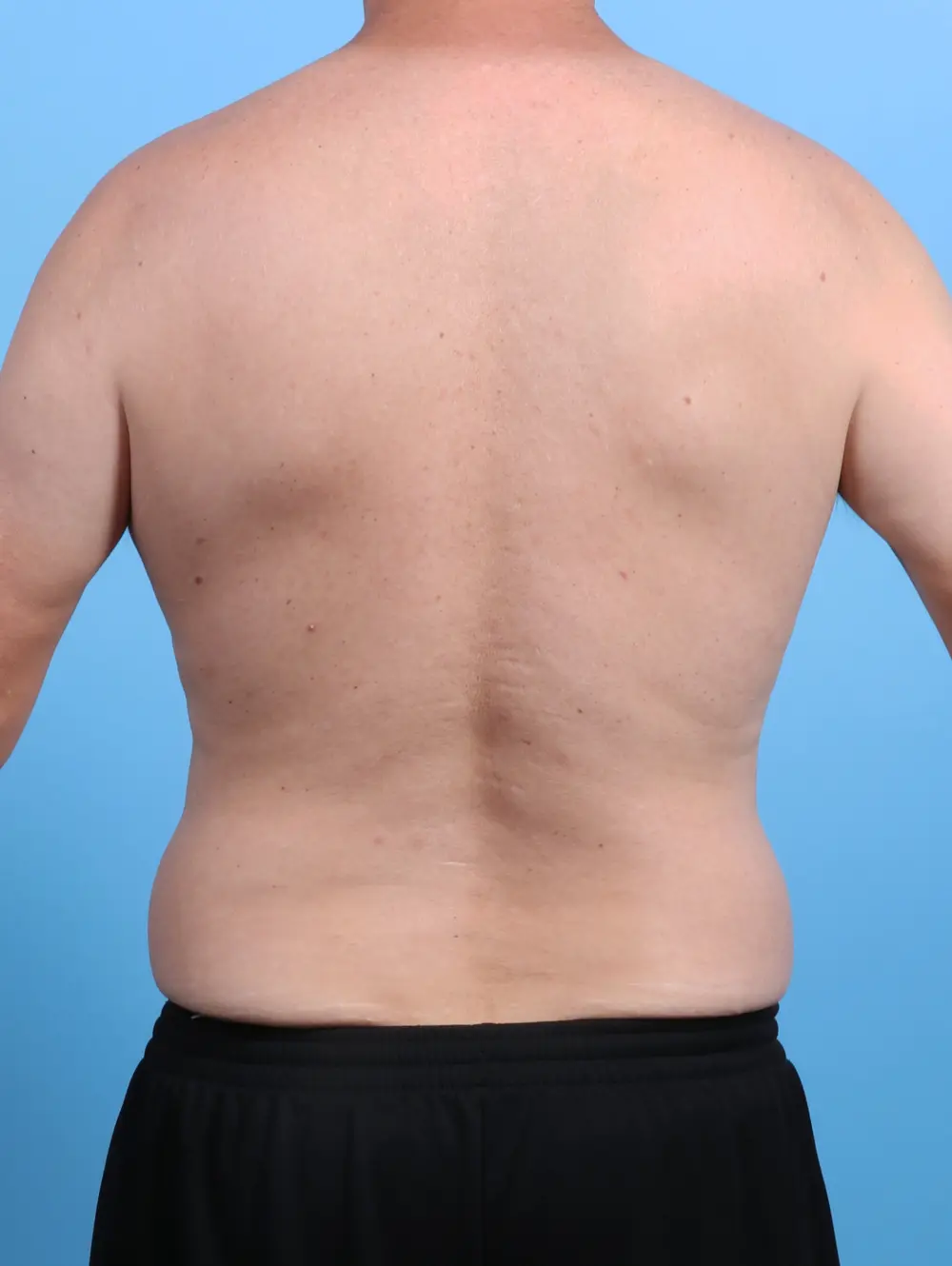 Male Liposuction Patient Photo - Case 26626 - before view-3