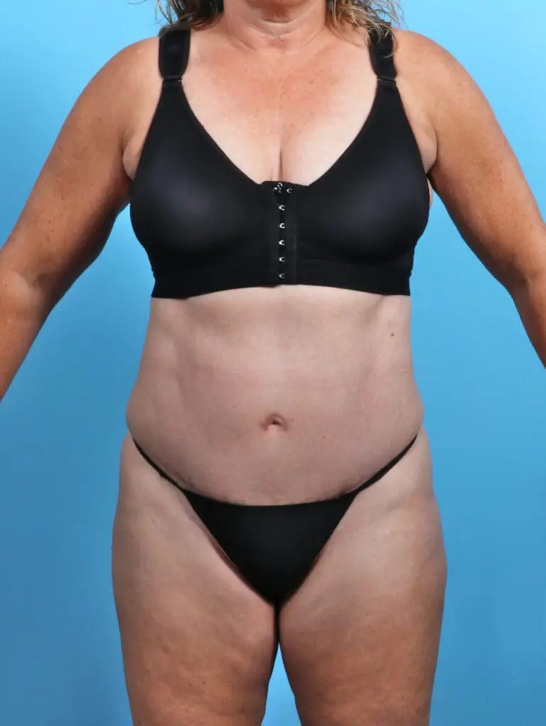 Tummy Tuck - Case 26638 - After