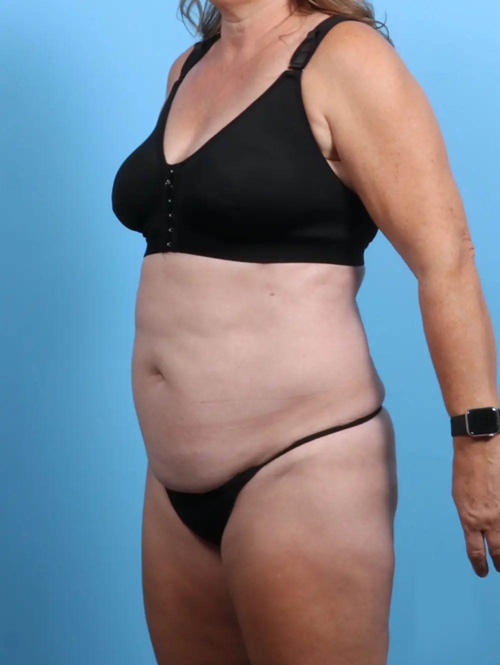 Tummy Tuck Patient Photo - Case 26638 - before view-1