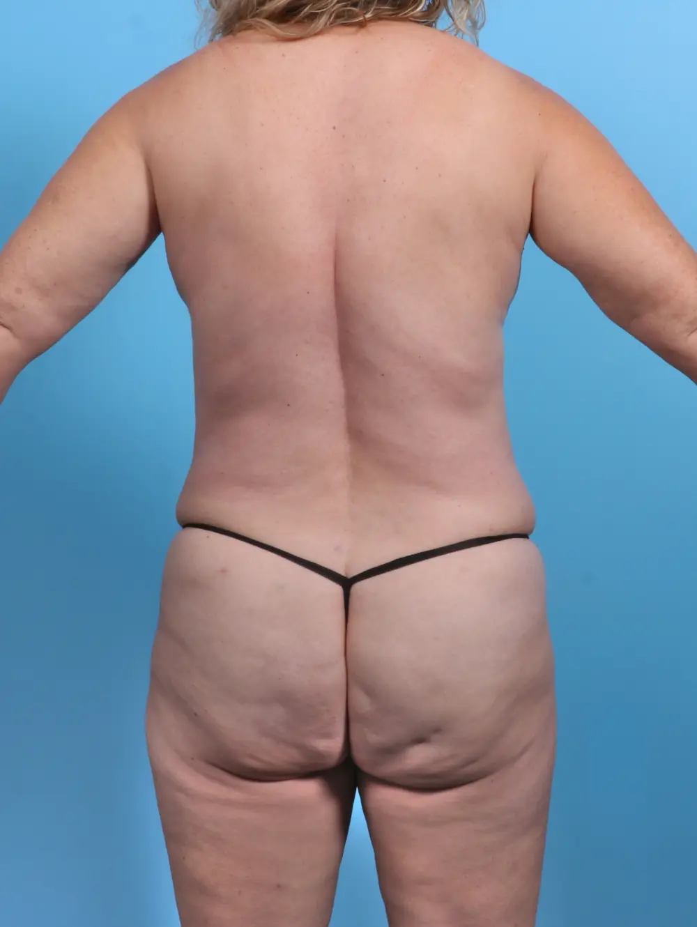 Tummy Tuck Patient Photo - Case 26638 - after view-3