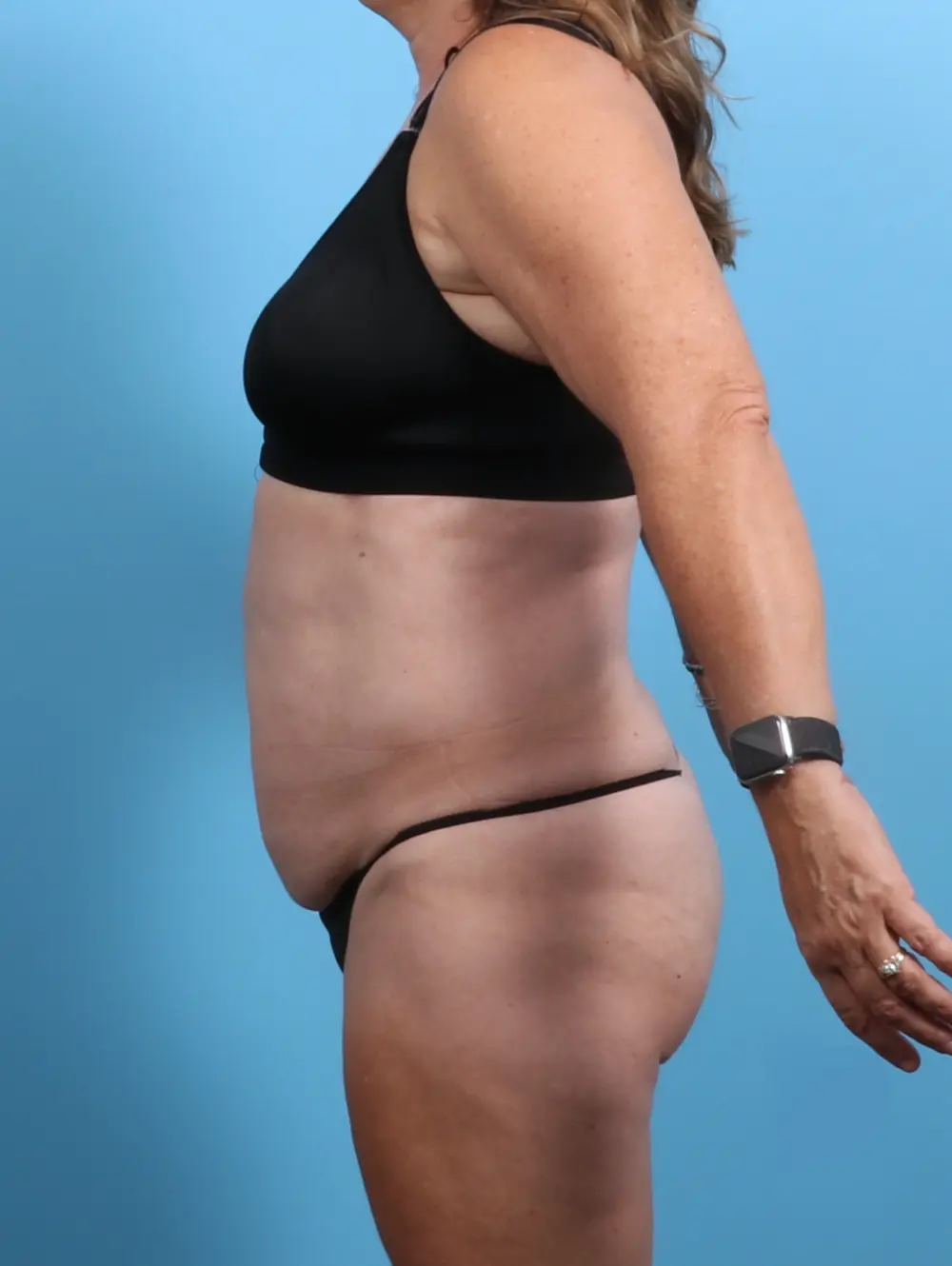 Tummy Tuck Patient Photo - Case 26638 - before view-2