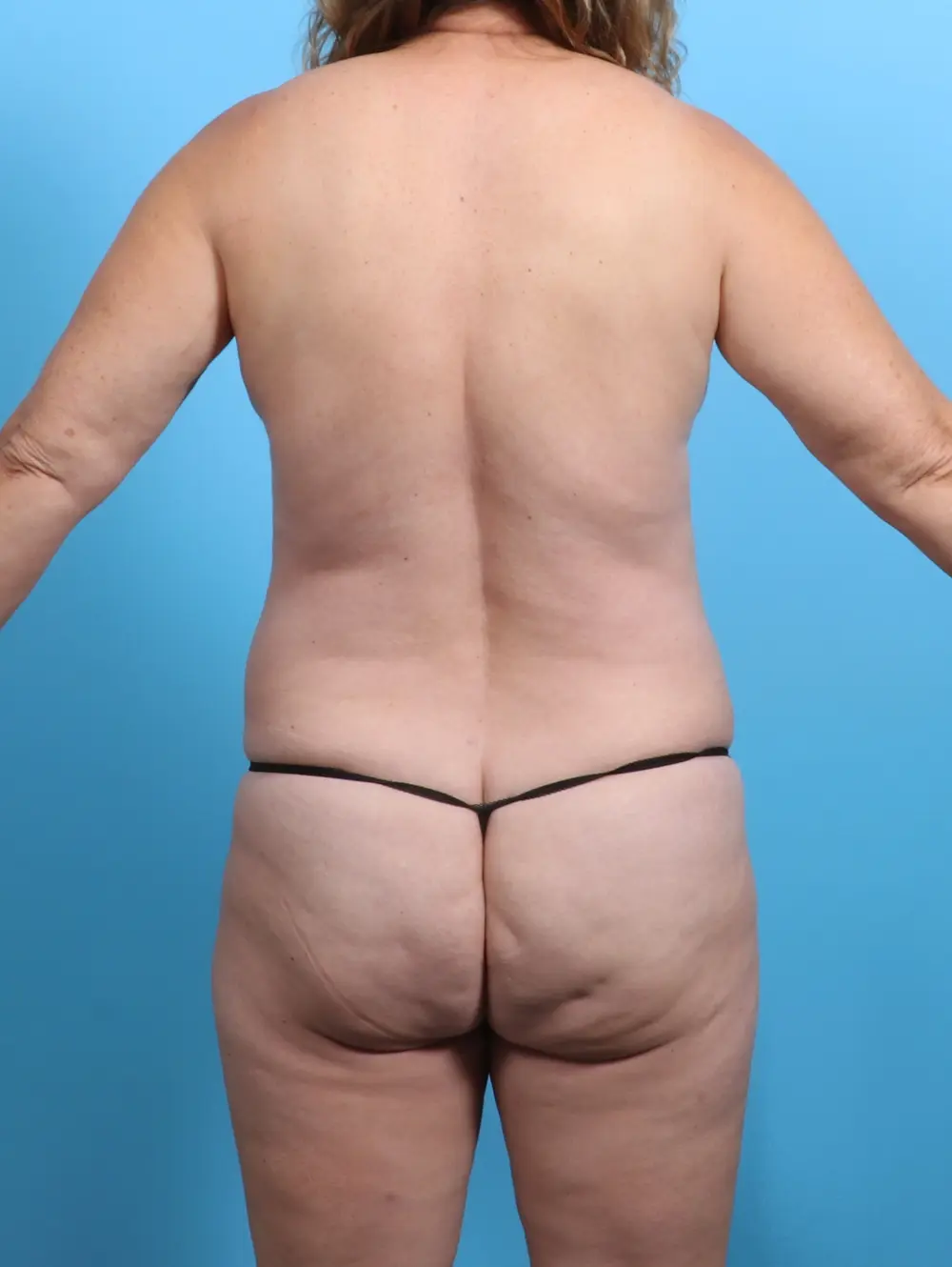 Tummy Tuck Patient Photo - Case 26638 - before view-3