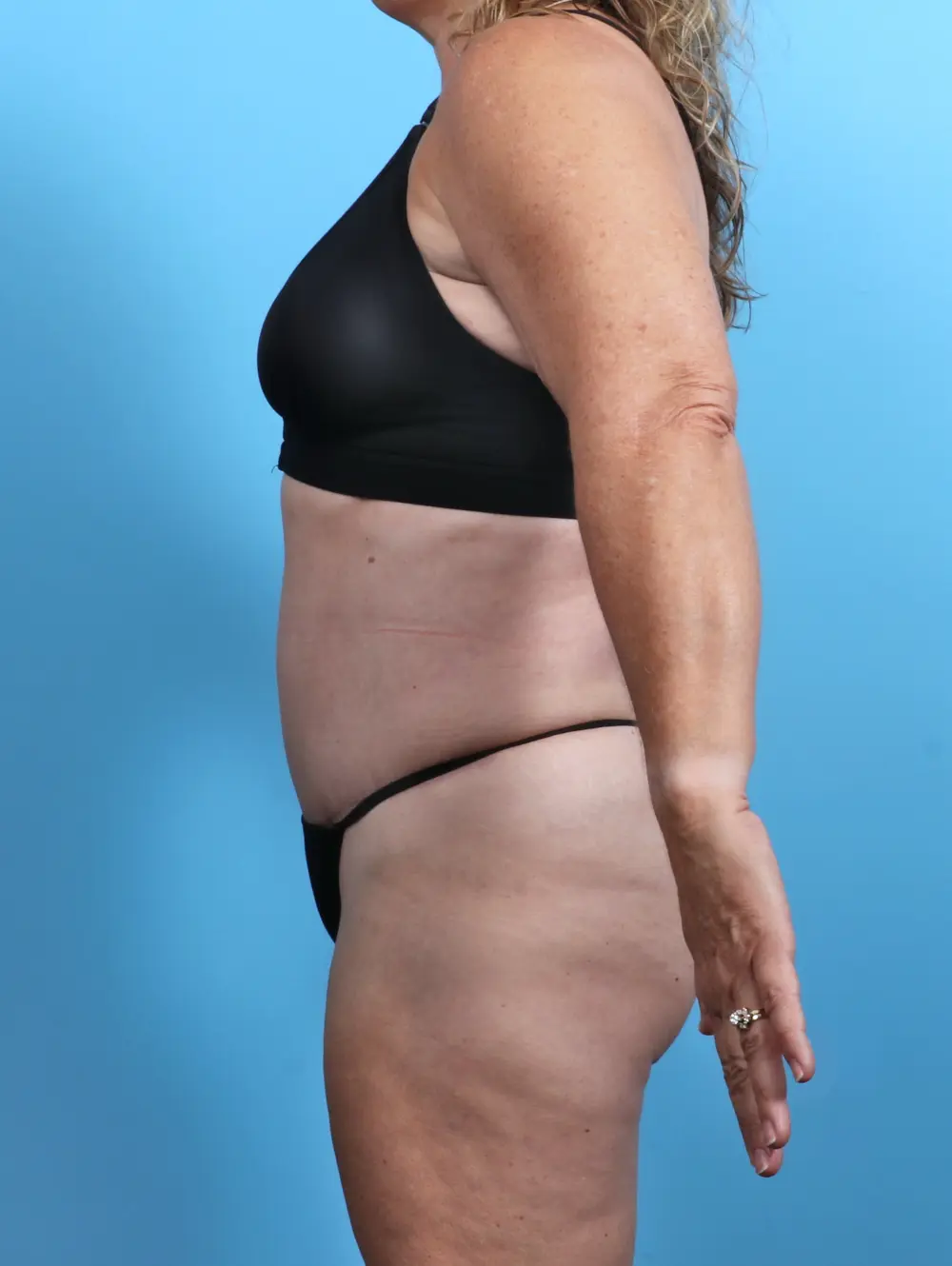Tummy Tuck Patient Photo - Case 26638 - after view-2