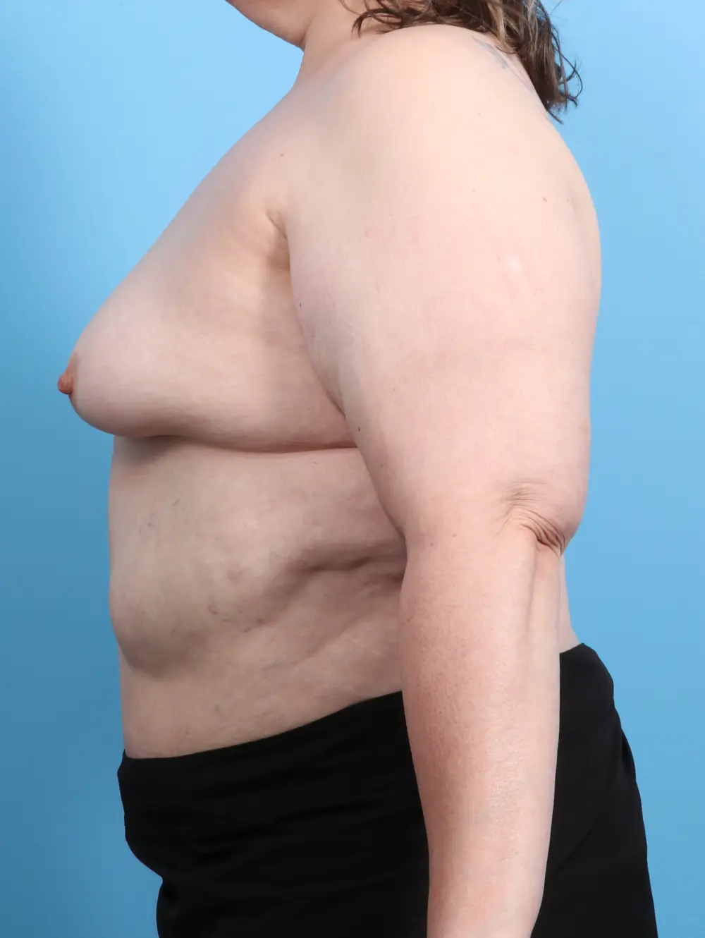Breast Augmentation Patient Photo - Case 26725 - before view-2