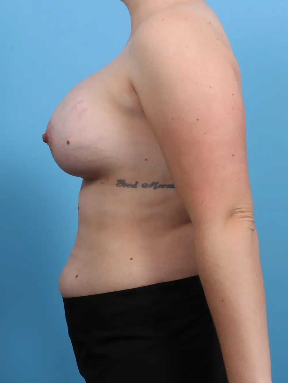 Breast Augmentation Patient Photo - Case 26733 - after view-2
