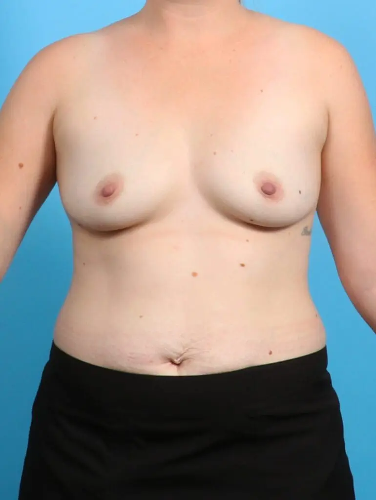 Breast Augmentation - Case 26733 - Before