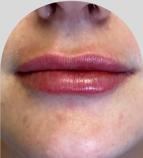 Lip Fillers - Case 26775 - After