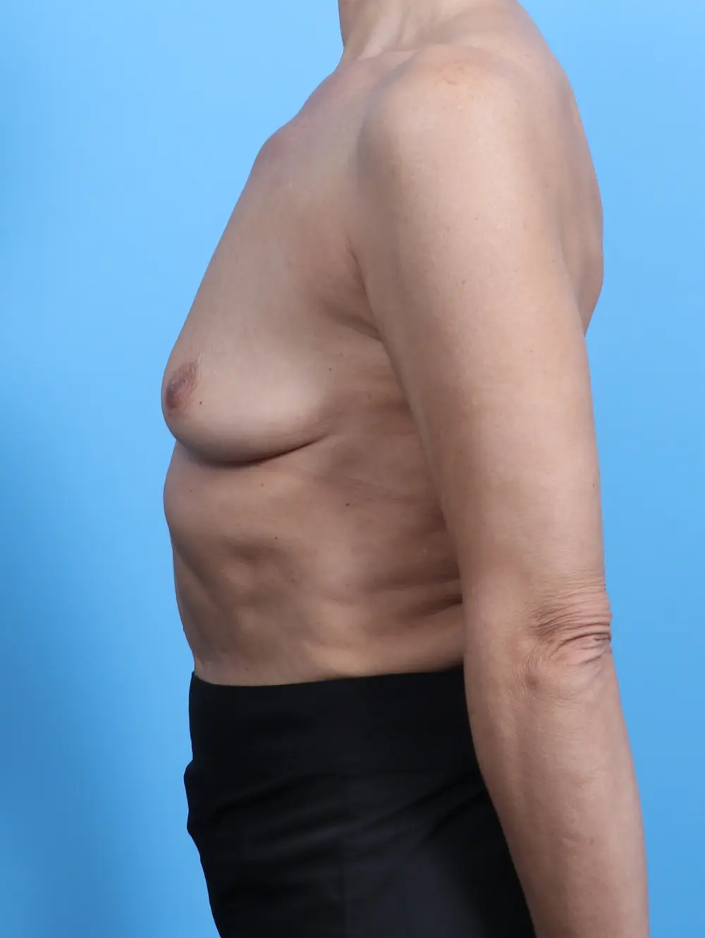 Breast Augmentation Patient Photo - Case 26798 - before view-2