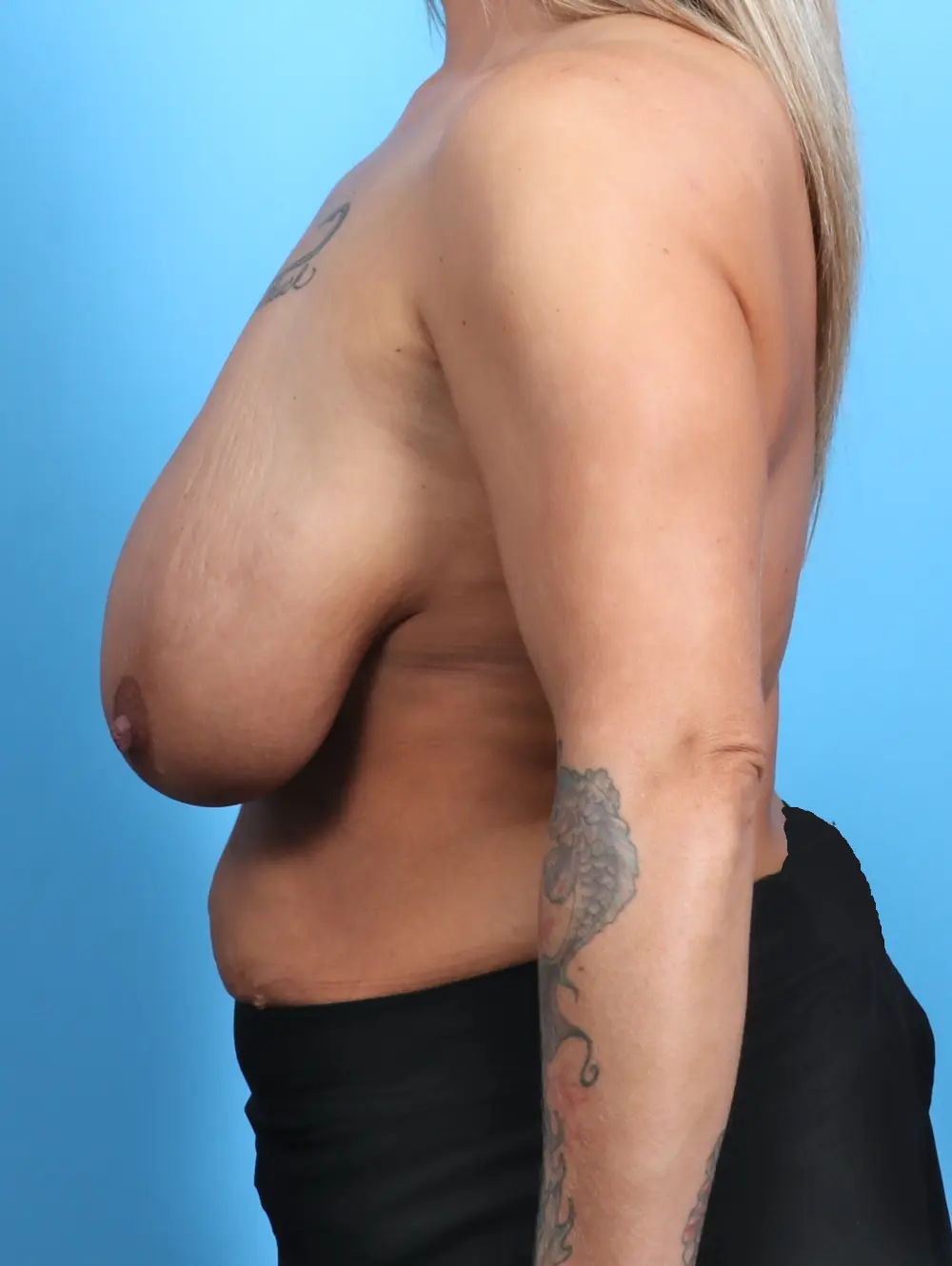 Breast Lift/Reduction w/o Implants Patient Photo - Case 26814 - before view-2