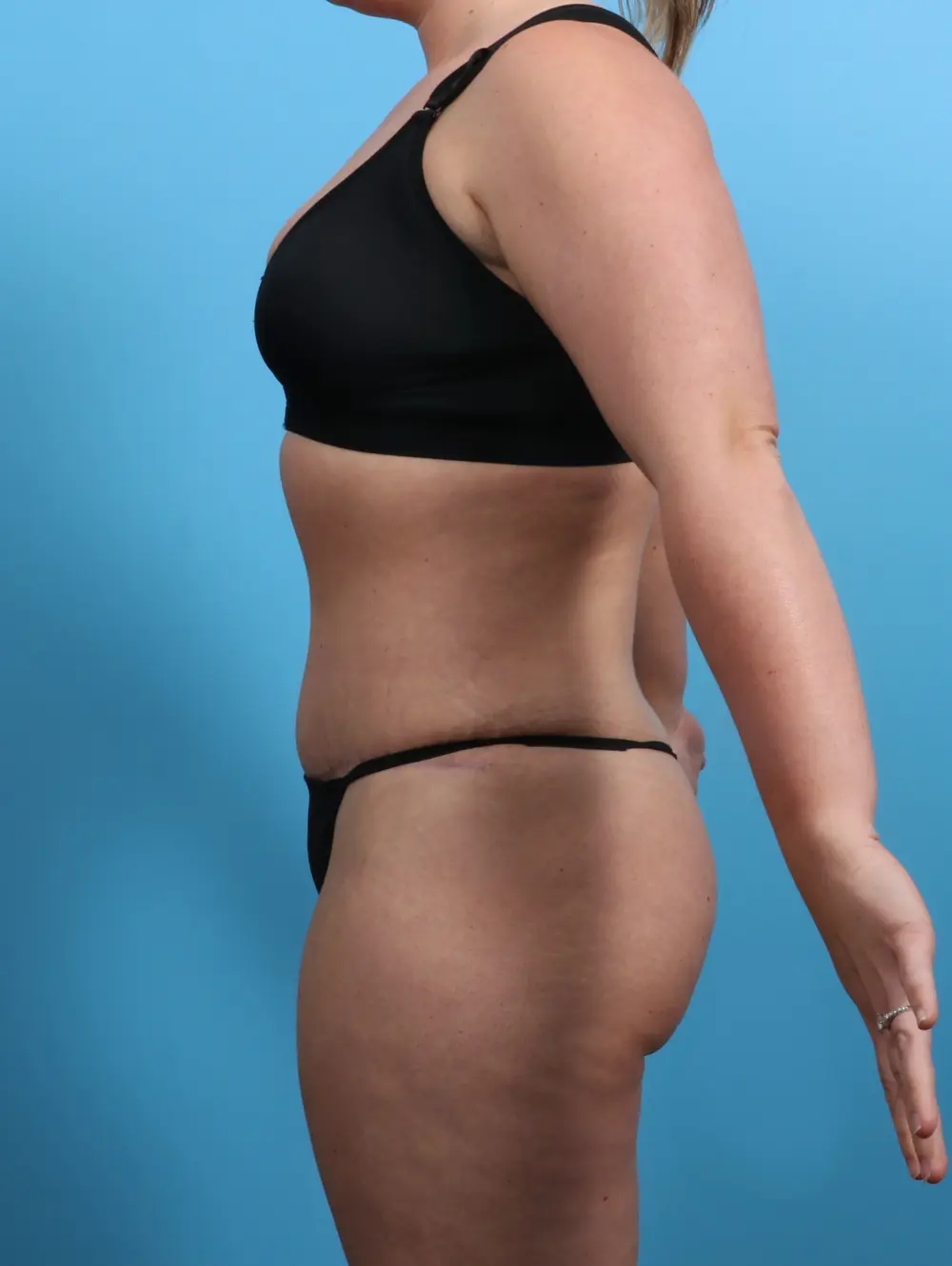 Tummy Tuck Patient Photo - Case 26830 - after view-2