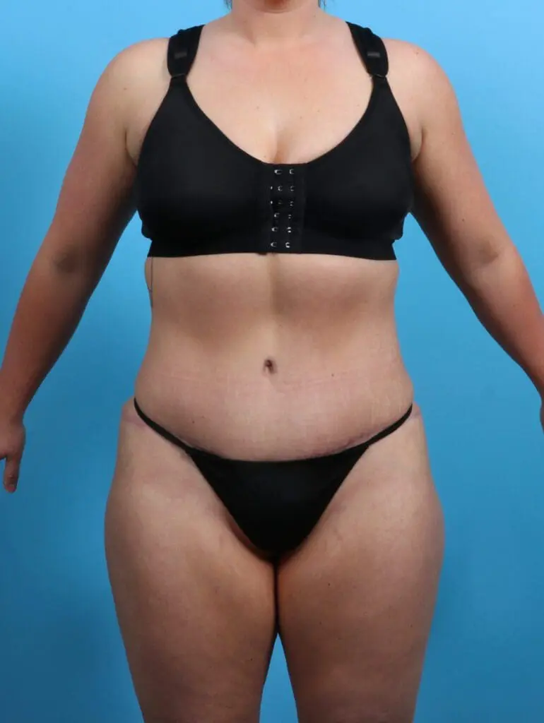 Tummy Tuck - Case 26830 - After