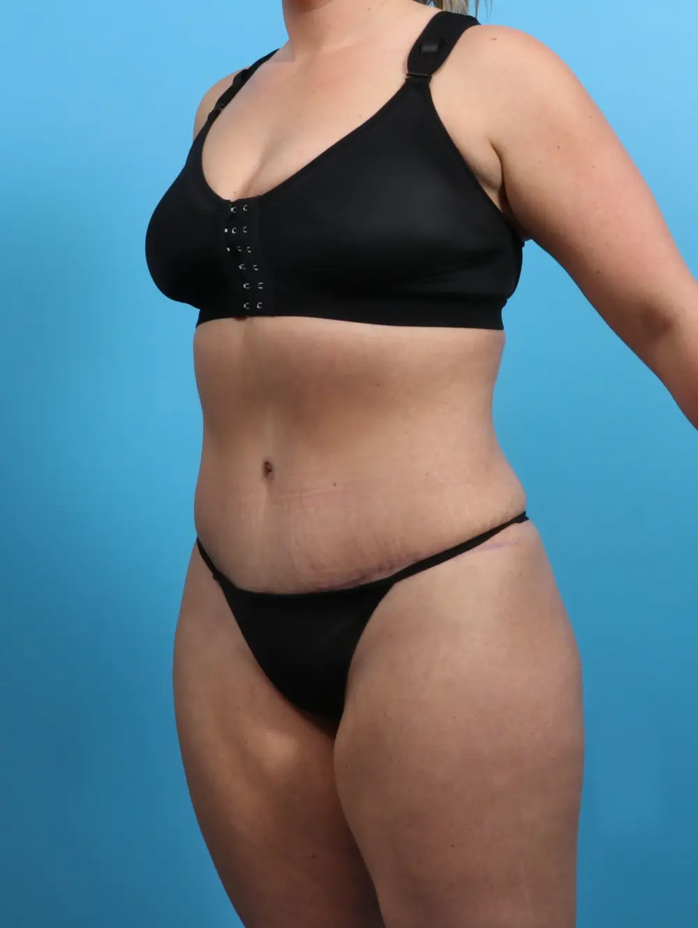 Tummy Tuck Patient Photo - Case 26830 - after view-1