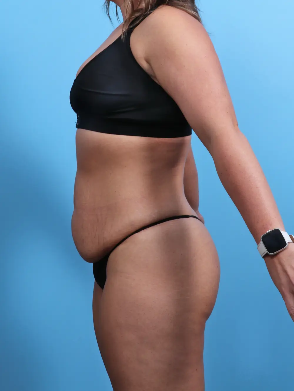 Tummy Tuck Patient Photo - Case 26830 - before view-2