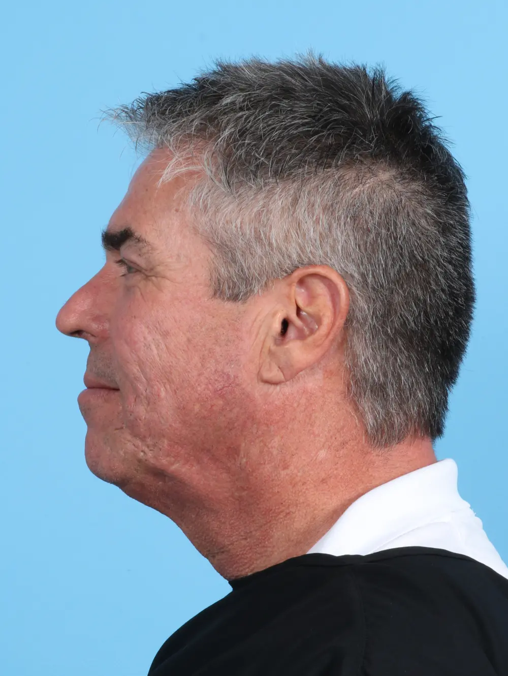 Facelift / Neck Lift Patient Photo - Case 26855 - before view-2