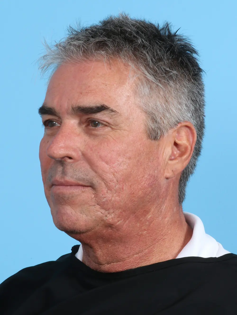 Facelift / Neck Lift Patient Photo - Case 26855 - before view-1