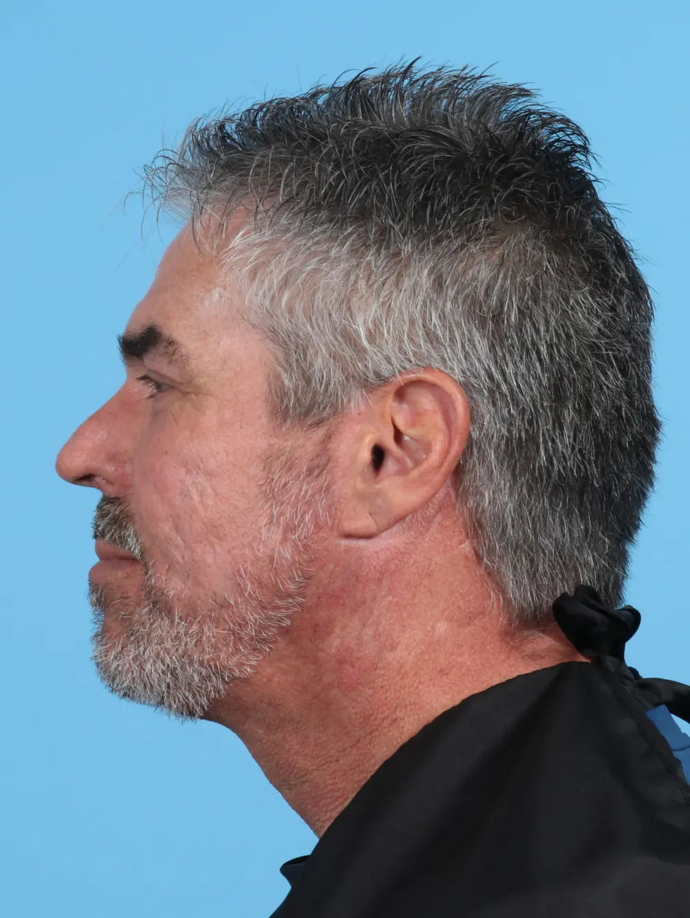 Facelift / Neck Lift Patient Photo - Case 26855 - after view-2