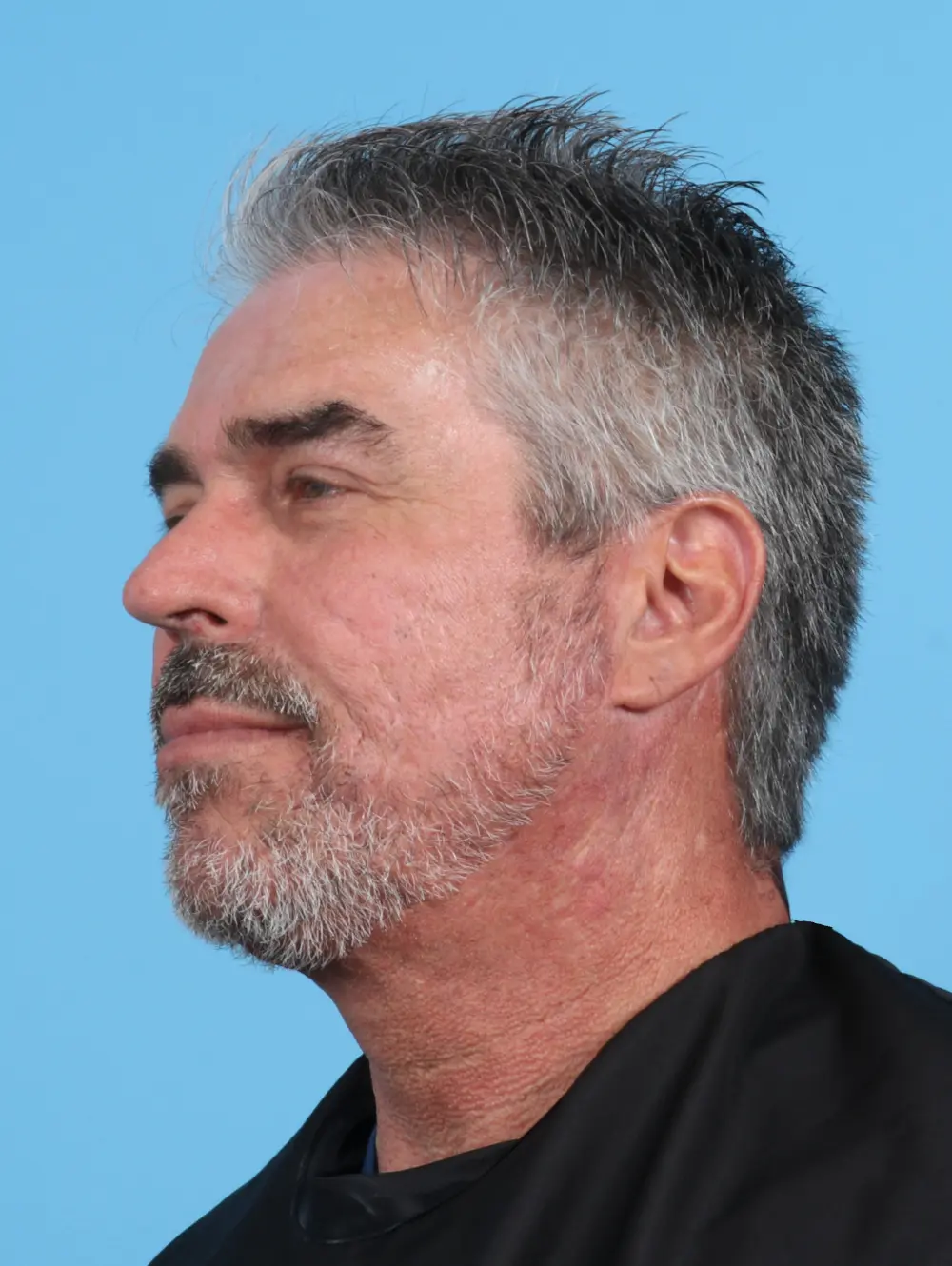 Facelift / Neck Lift Patient Photo - Case 26855 - after view-1