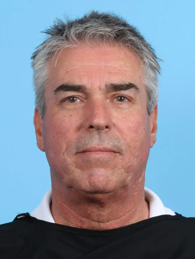 Facelift / Neck Lift - Case 26855 - Before