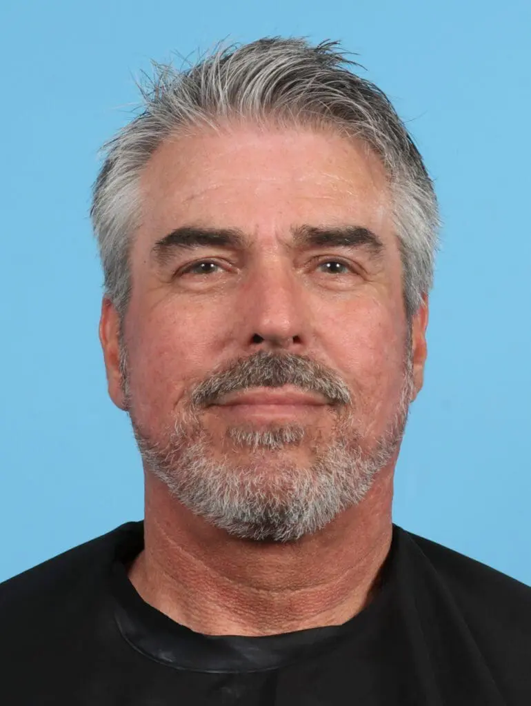 Facelift / Neck Lift - Case 26855 - After