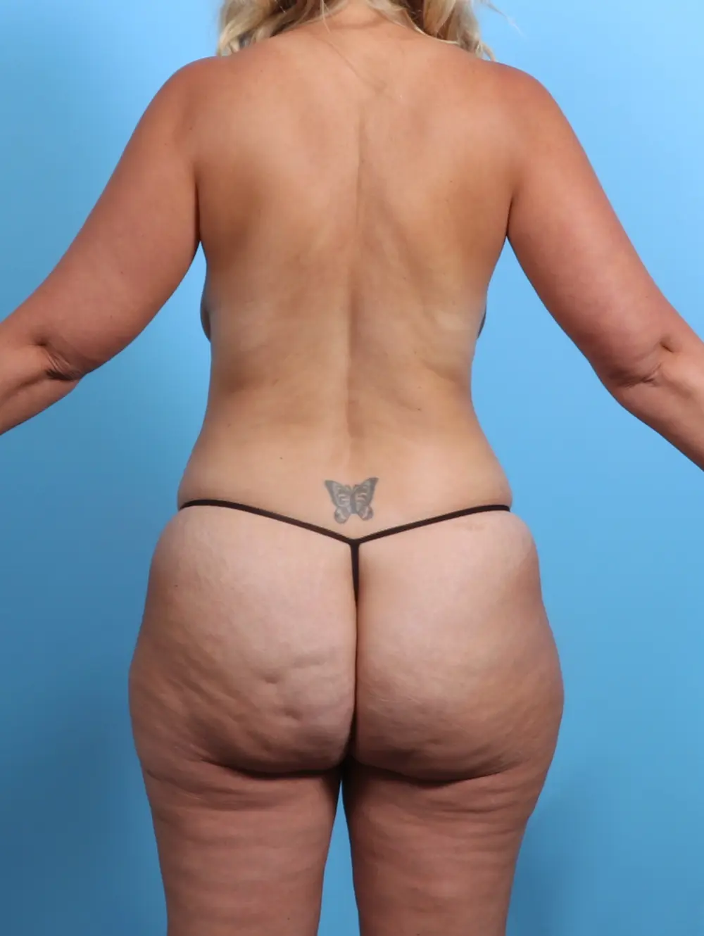 Body Lift Patient Photo - Case 26863 - before view-3