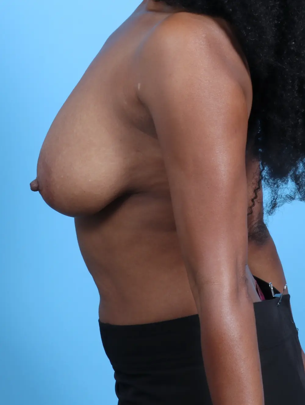 Breast Lift/Reduction w/o Implants Patient Photo - Case 26874 - before view-2