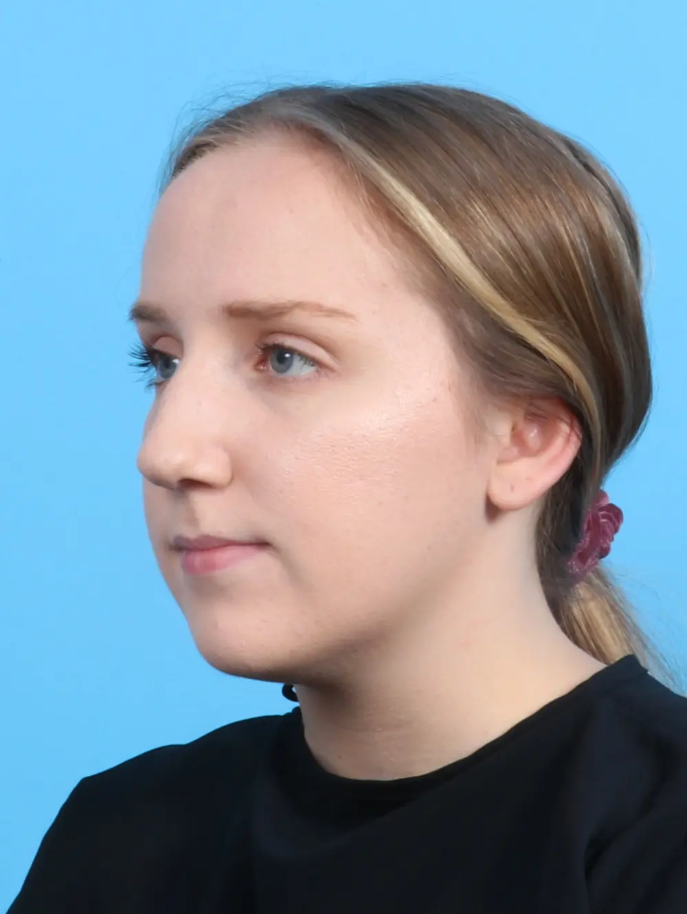 Rhinoplasty Patient Photo - Case 26882 - before view-1