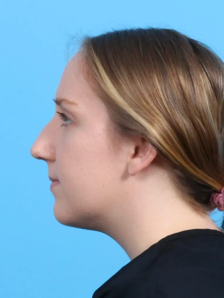 Rhinoplasty - Case 26882 - Before