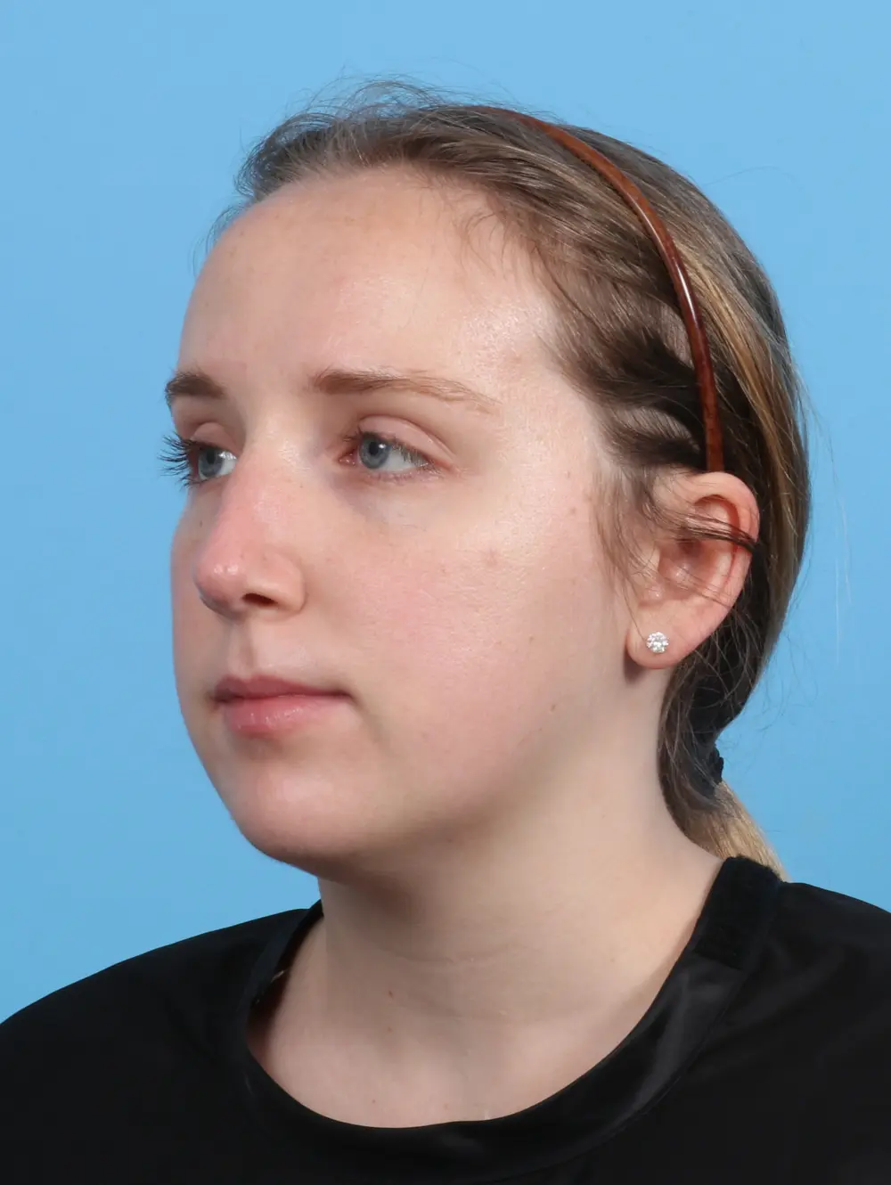Rhinoplasty Patient Photo - Case 26882 - after view-1