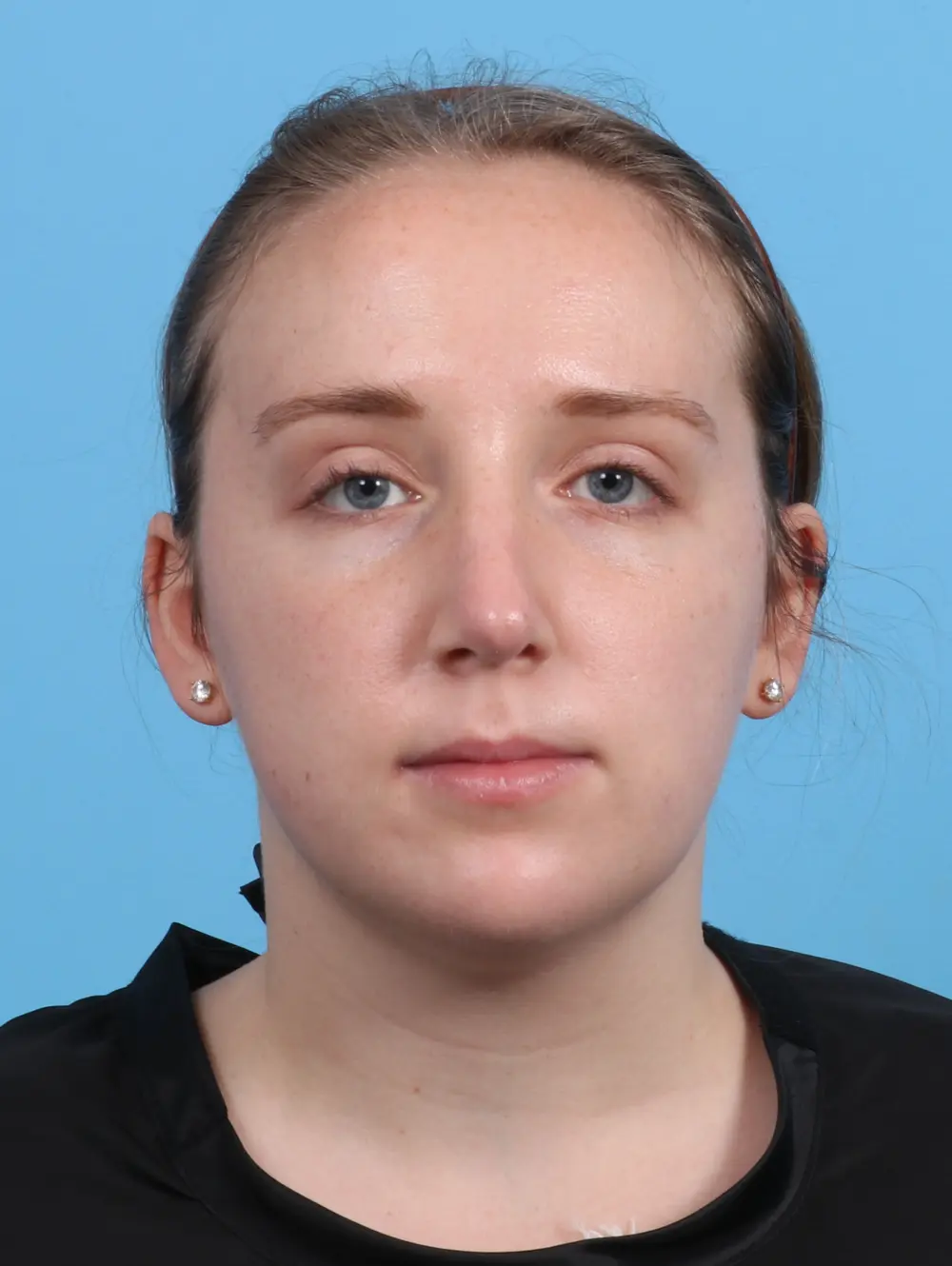 Rhinoplasty Patient Photo - Case 26882 - after view-2