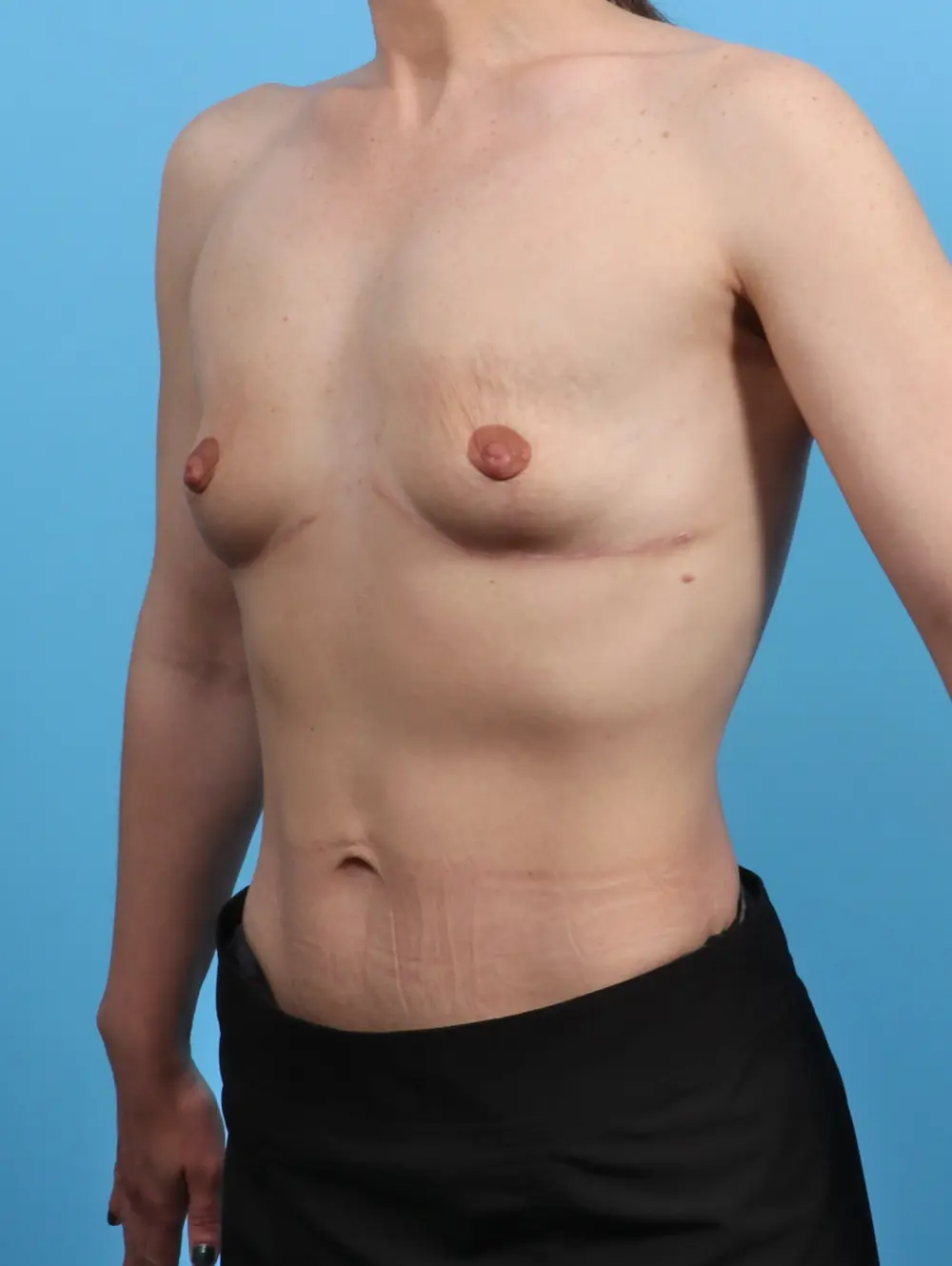 Breast Implant Removal Patient Photo - Case 26890 - after view-1