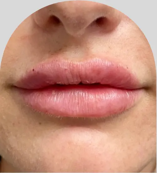 Lip Fillers - Case 26903 - After