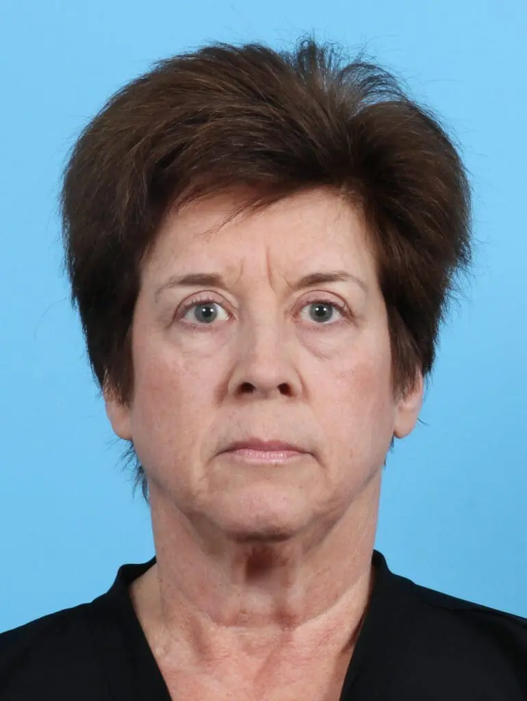 Eyelid Surgery - Case 26920 - After