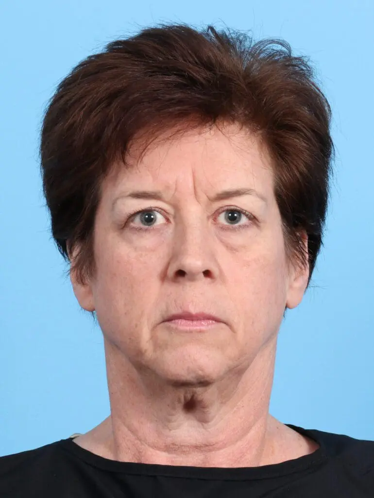 Eyelid Surgery - Case 26920 - Before