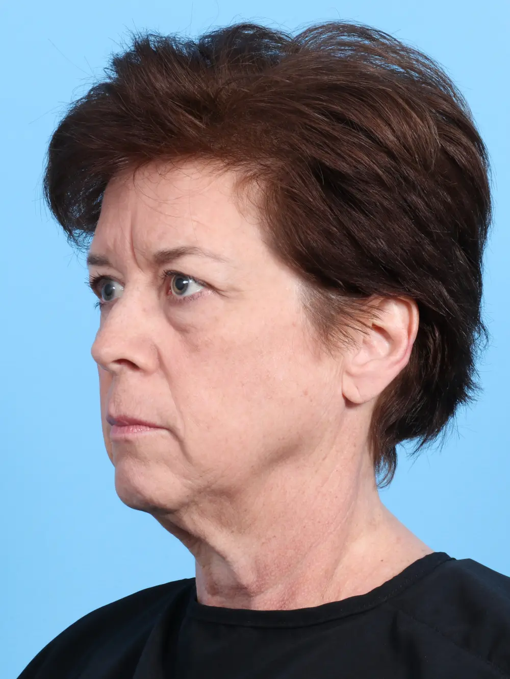 Eyelid Surgery Patient Photo - Case 26920 - before view-1