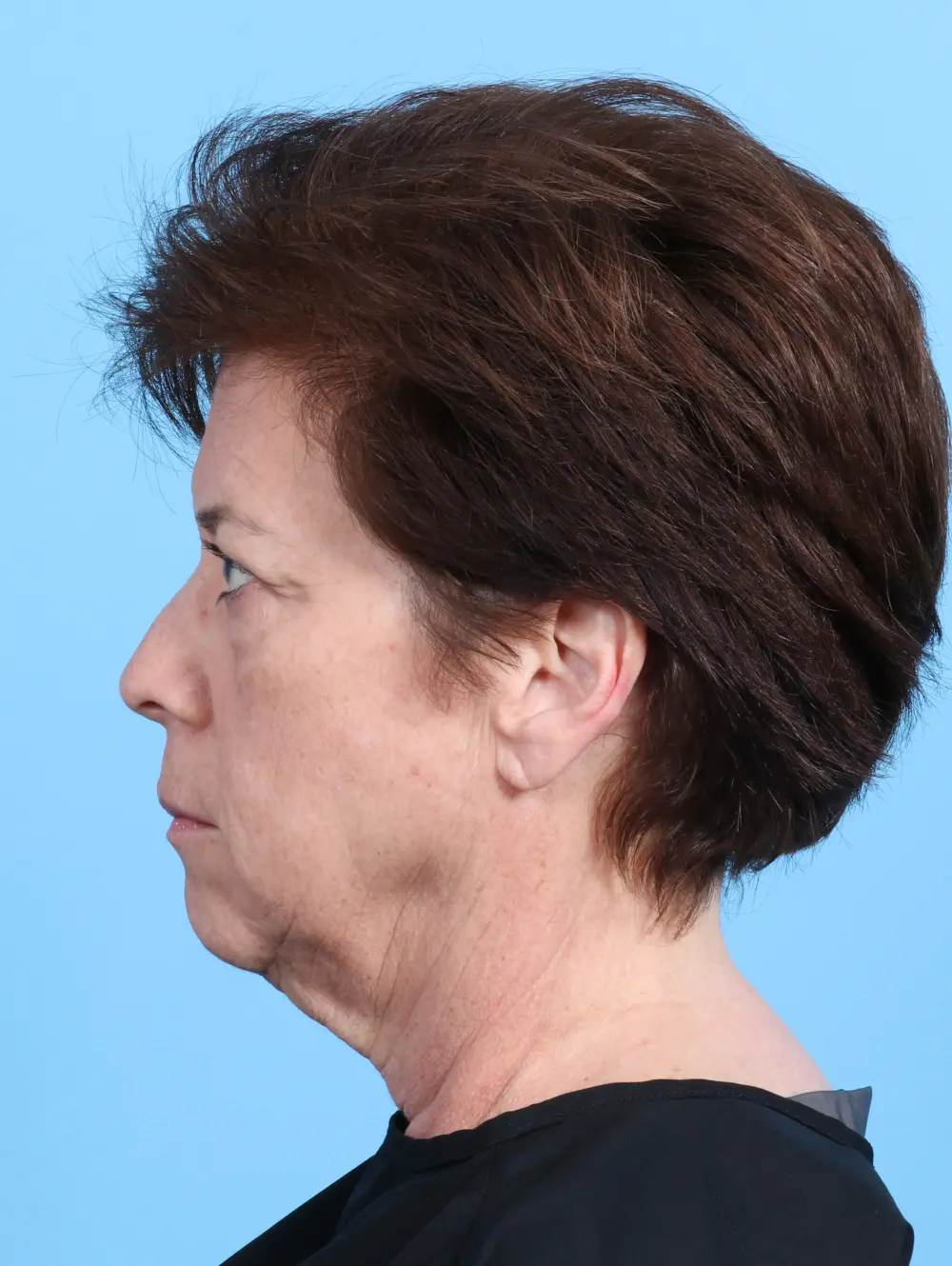 Eyelid Surgery Patient Photo - Case 26920 - before view-2