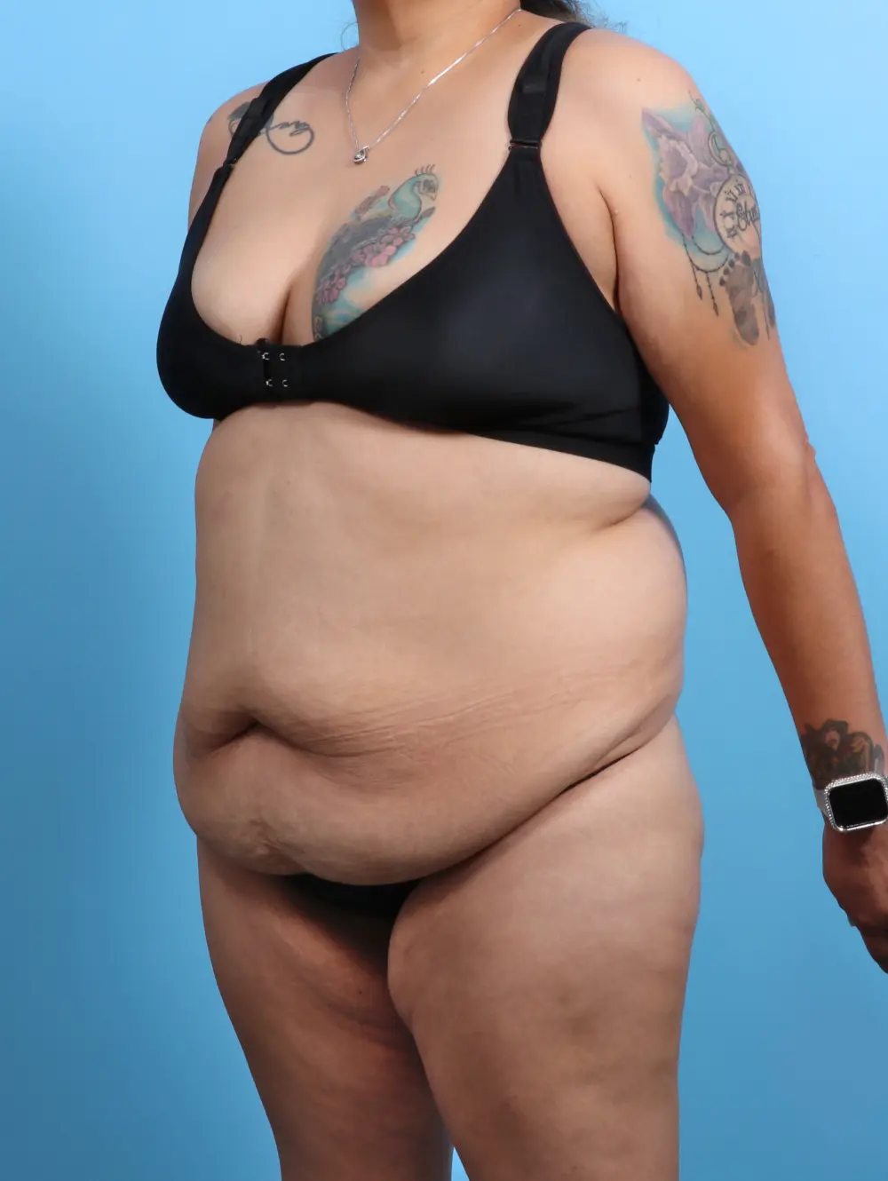 Tummy Tuck Patient Photo - Case 26928 - before view-1