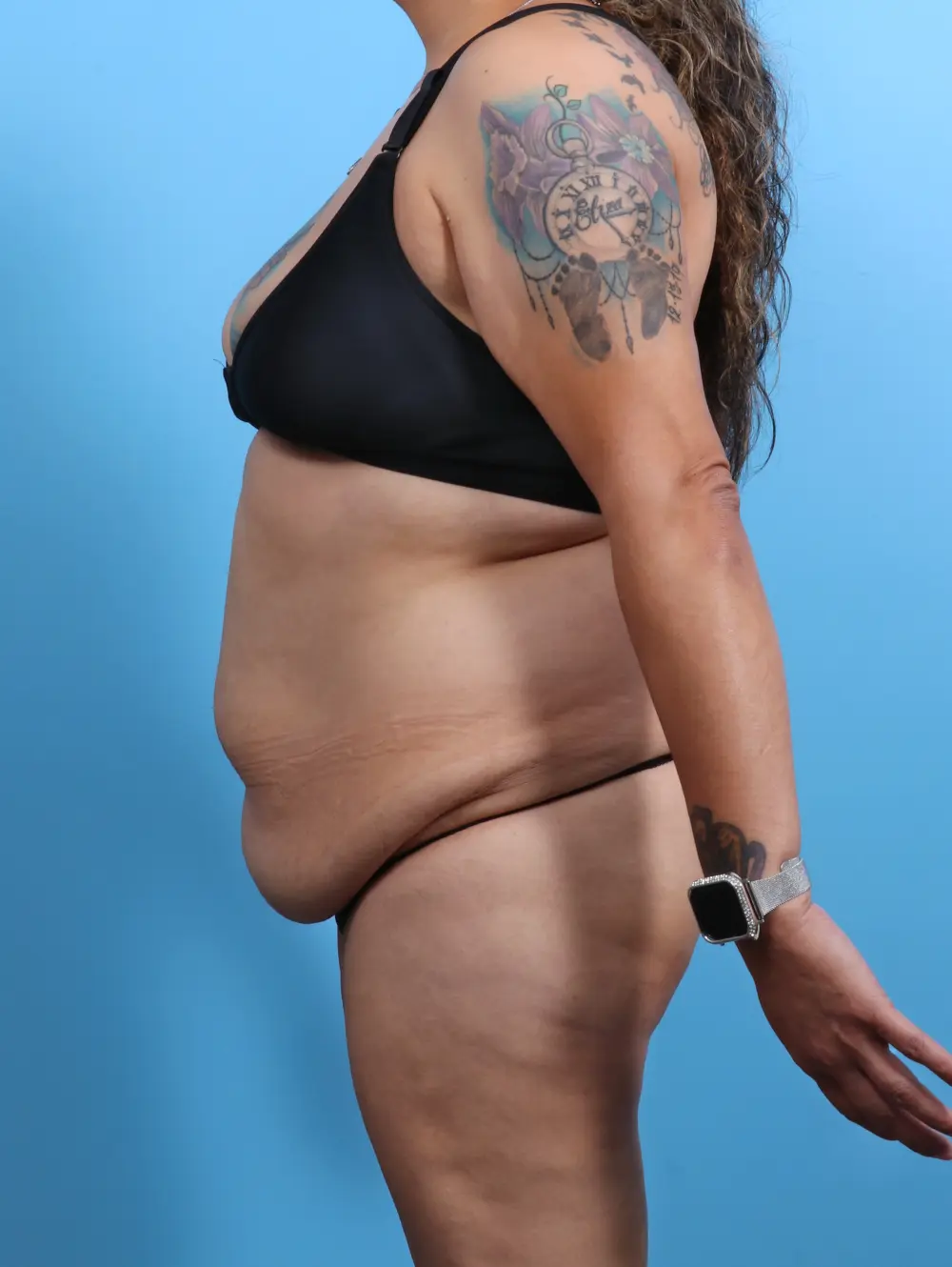 Tummy Tuck Patient Photo - Case 26928 - before view-2