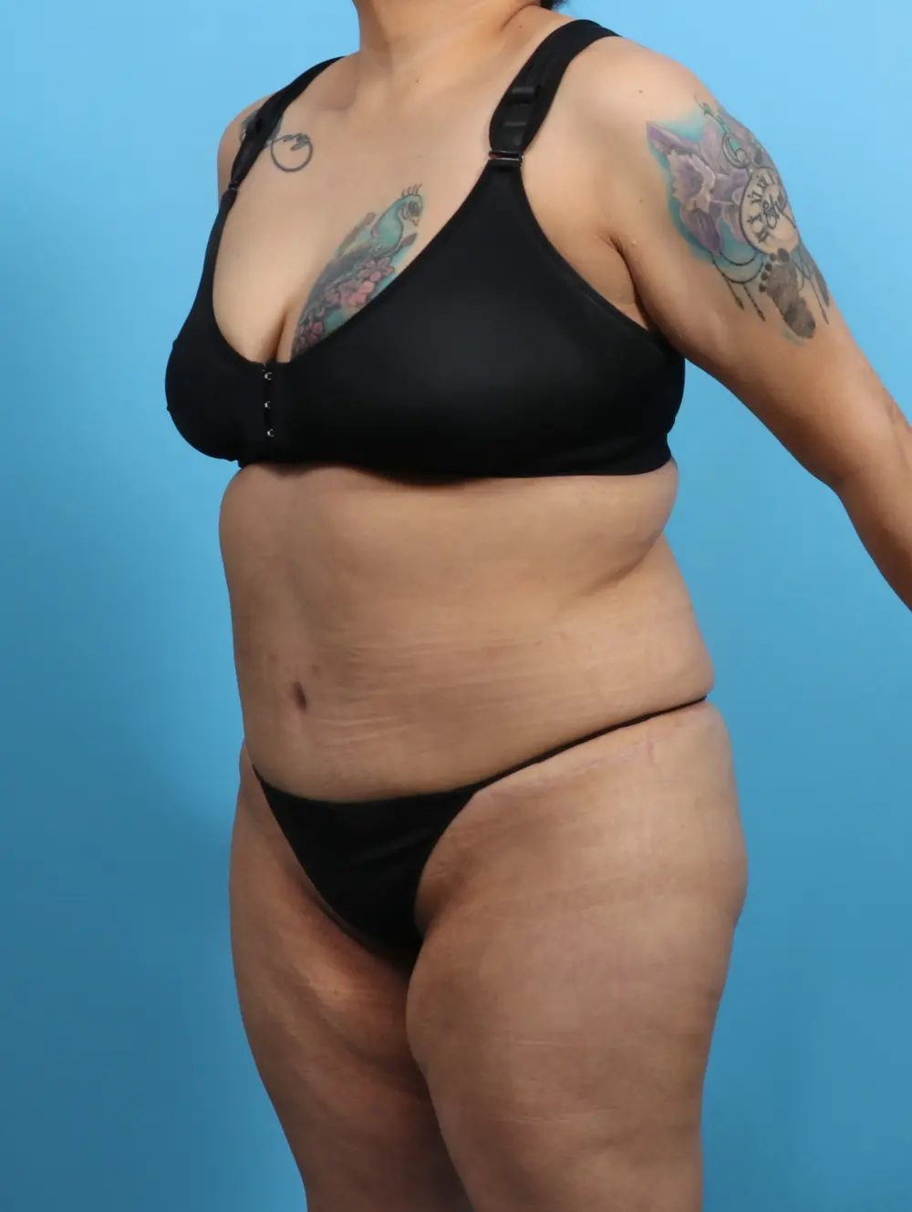 Tummy Tuck Patient Photo - Case 26928 - after view-1