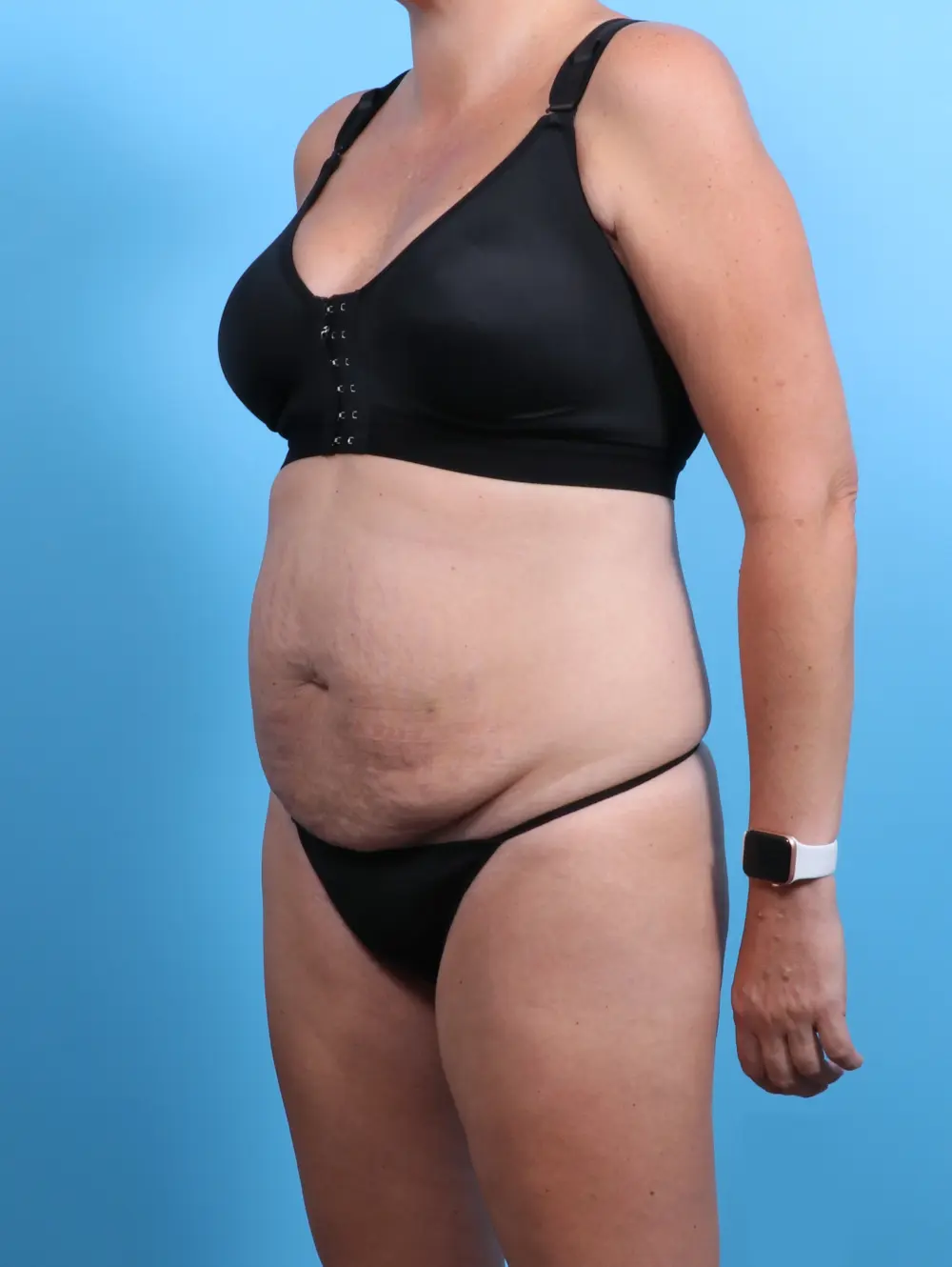 Tummy Tuck Patient Photo - Case 26946 - before view-1