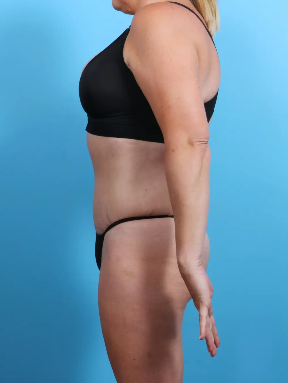 Tummy Tuck Patient Photo - Case 26946 - after view-2