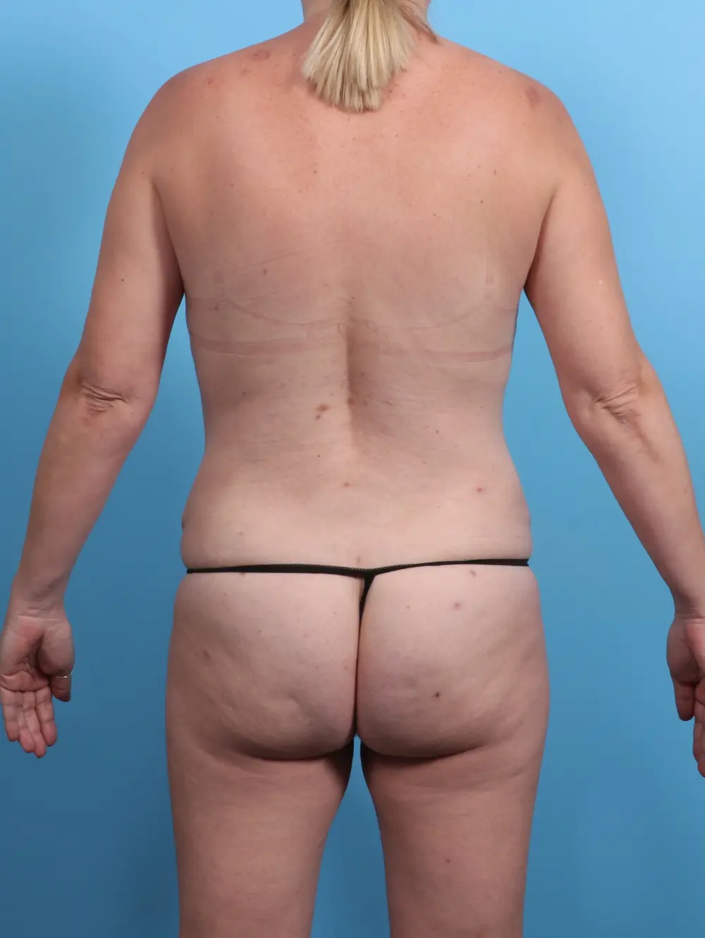 Tummy Tuck Patient Photo - Case 26946 - after view-3