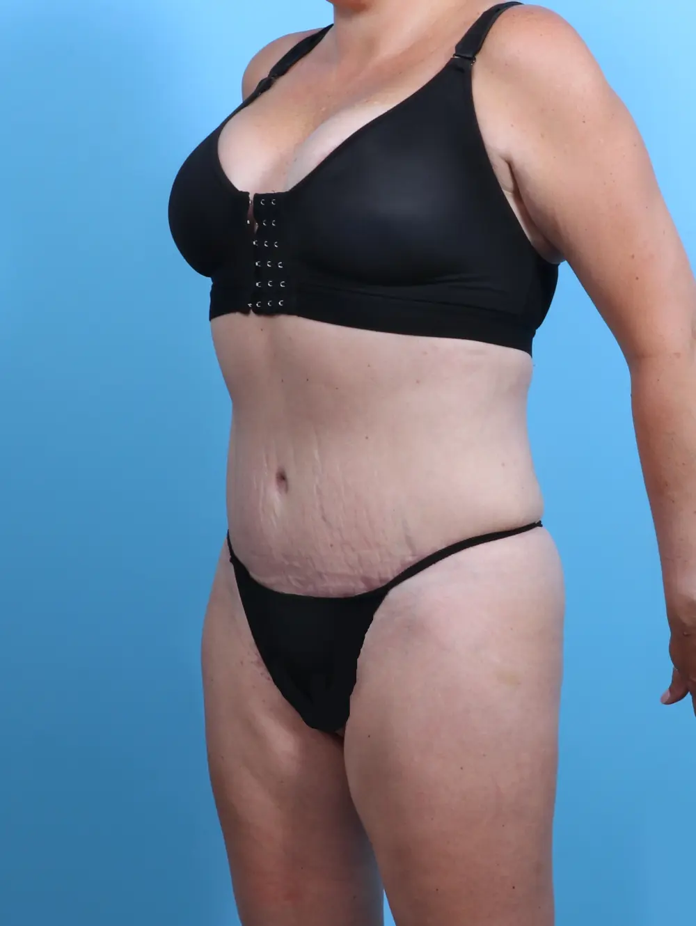 Tummy Tuck Patient Photo - Case 26946 - after view-1