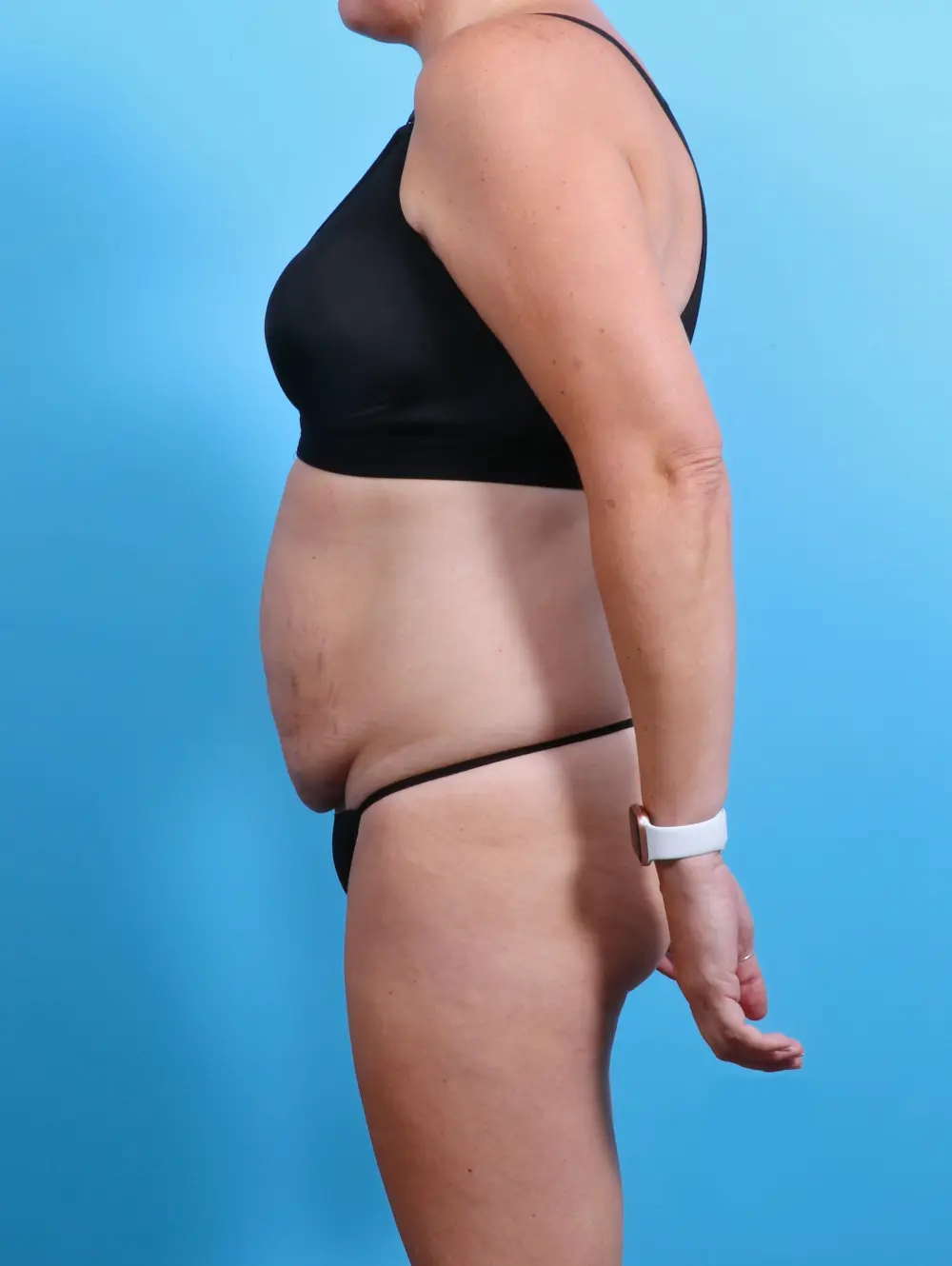 Tummy Tuck Patient Photo - Case 26946 - before view-2