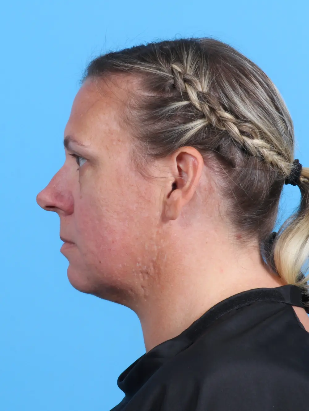 Eyelid Surgery Patient Photo - Case 26957 - before view-2