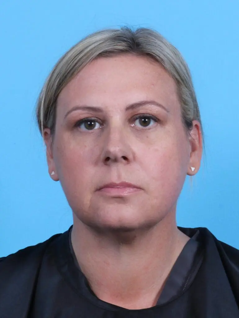 Eyelid Surgery - Case 26957 - After