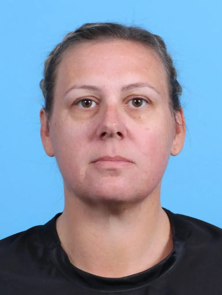 Eyelid Surgery - Case 26957 - Before